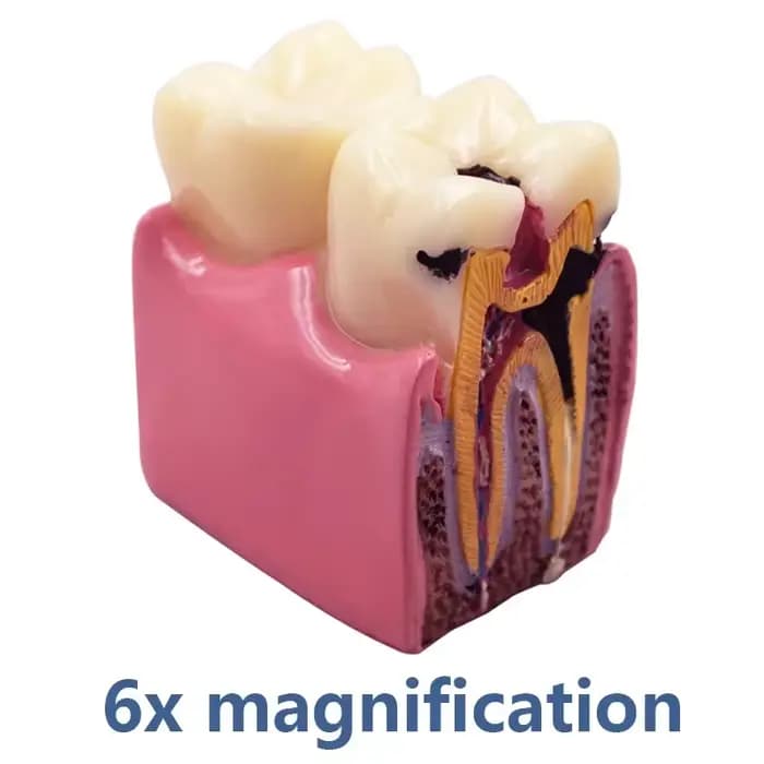 Modèle de caries dentaires 8 fois, modèle dentaire pour la maladie des dents, modèle de démonstratio