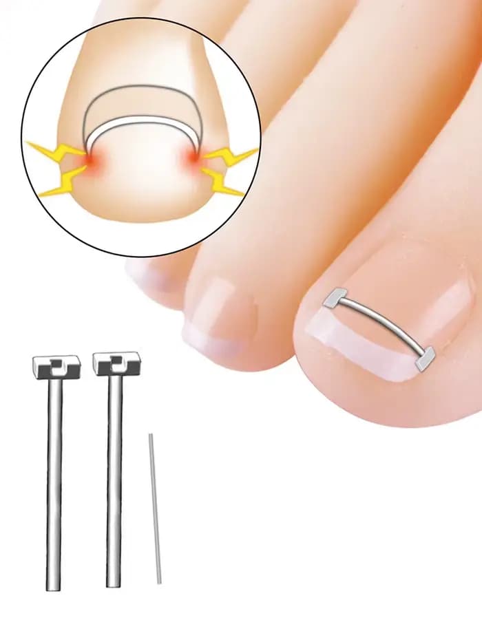 Outils de pédicure professionnels, traitement des ongles incarnés, gélatine de récupération, soins d