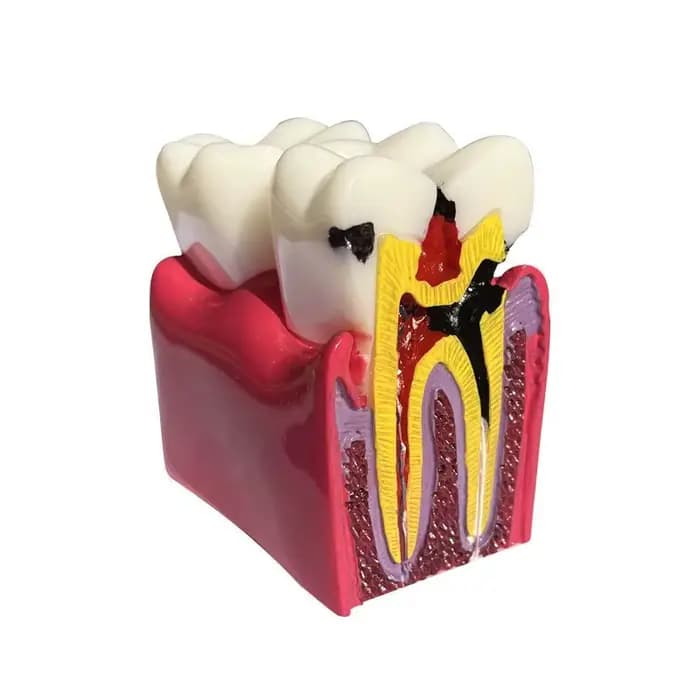Dentisterie, modèle de comparaison de caries Oral 6x, processus d'évolution de caries, modèle d'affichage de Communication d'enseignement de médecin-patient