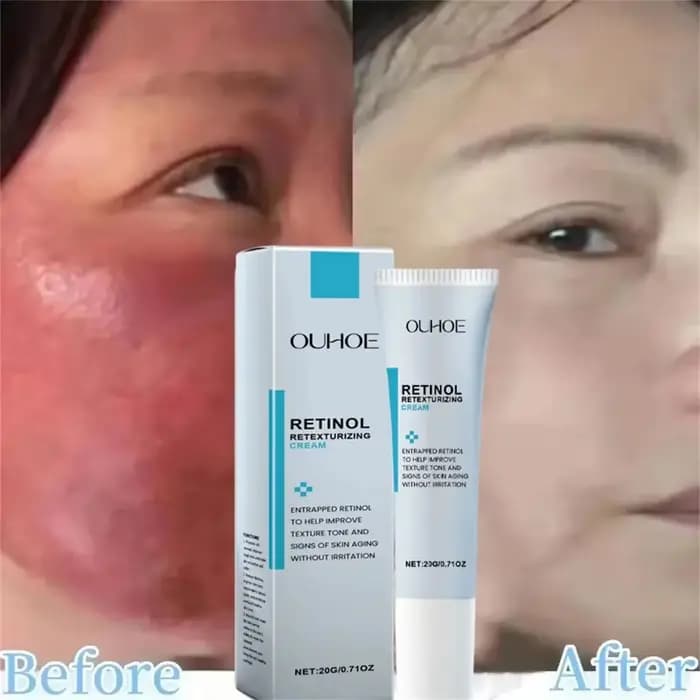 Crème réparatrice pour les rougeurs du visage