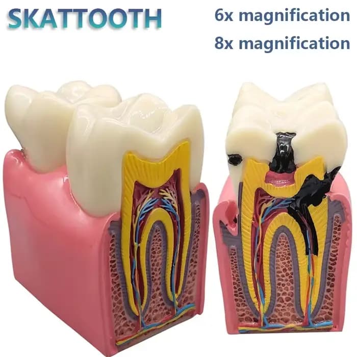 Modèle de caries dentaires 8 fois, modèle dentaire pour la maladie des dents, modèle de démonstration dentaire, enseignement du dentiste, laboratoire dentaire, recherche orale
