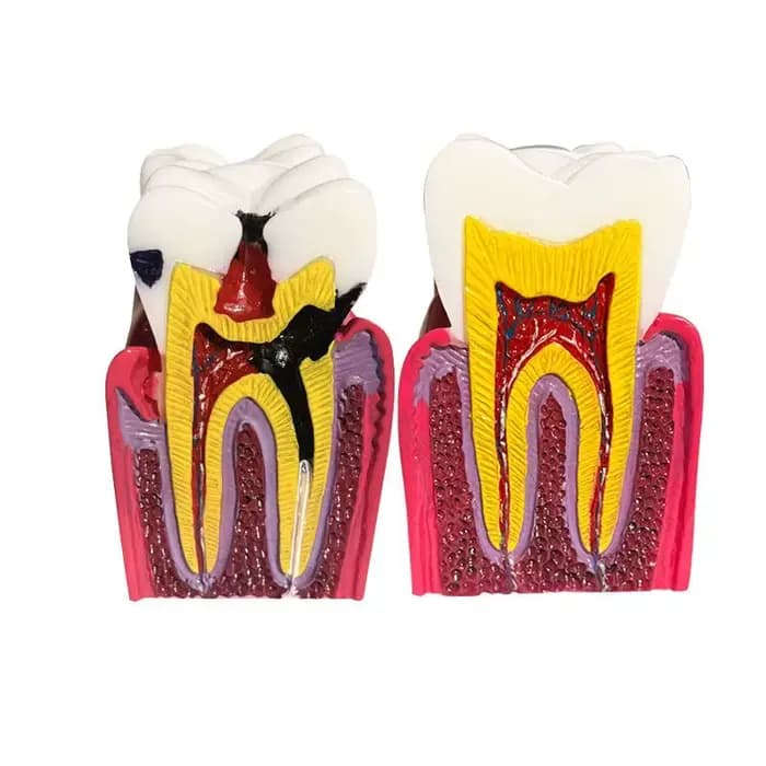 Dentisterie, modèle de comparaison de caries Oral 6x, processus d'évolution de caries, modèle d'affichage de Communication d'enseignement de médecin-patient