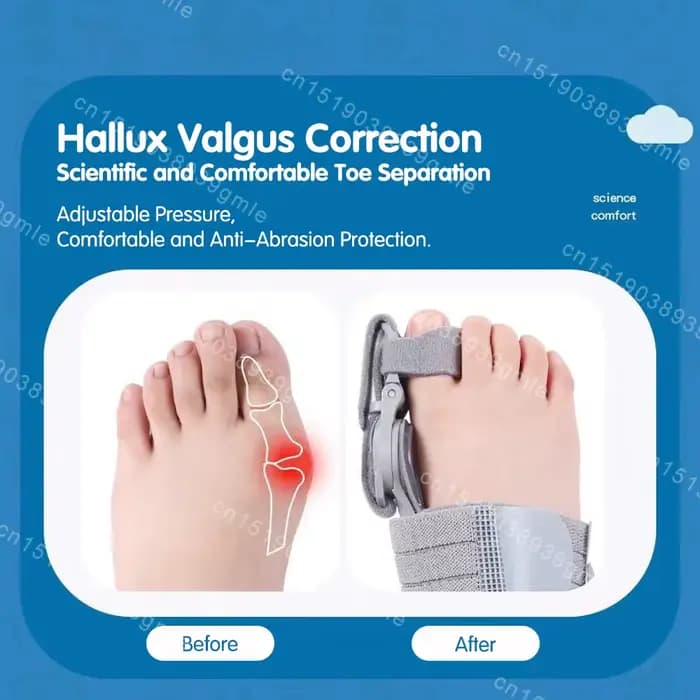 Correcteur d'oignon réglable Hallux Valgu correcteur de gros orteil Valgus correcteur d'orteil rotatif lisseur Correction d'orteil réglable