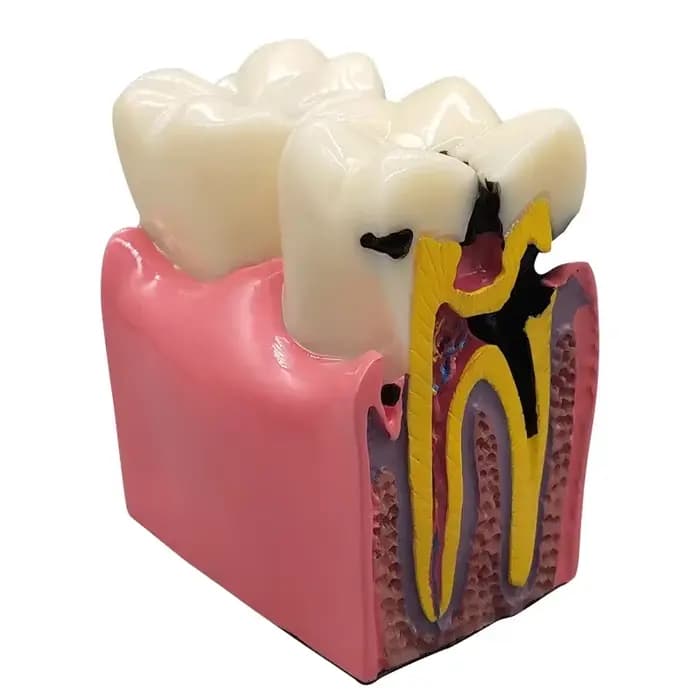Modèle de caries dentaires 8 fois, modèle dentaire pour la maladie des dents, modèle de démonstration dentaire, enseignement du dentiste, laboratoire dentaire, recherche orale