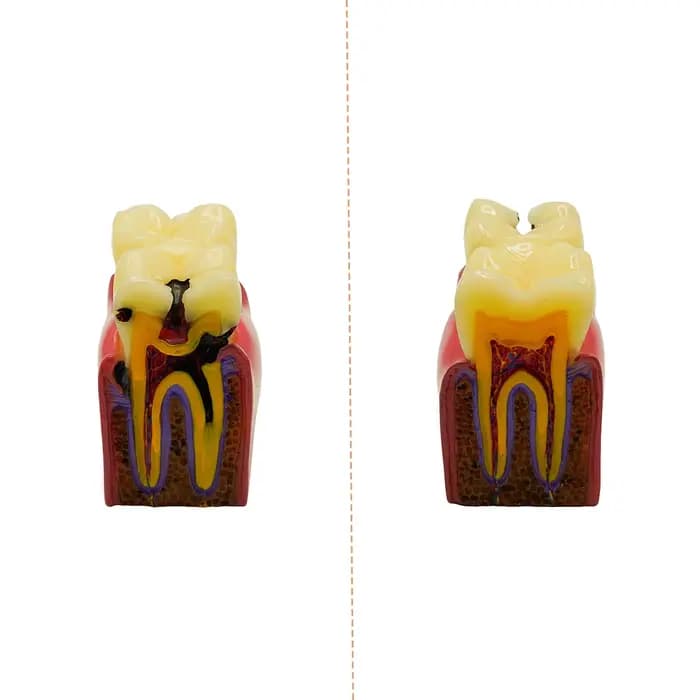Modèles dentaires de comparaison de caries 6 fois, modèles d'étude pour dentiste, enseignement, pratique de l'anatomie, modèle de dents de dentisterie