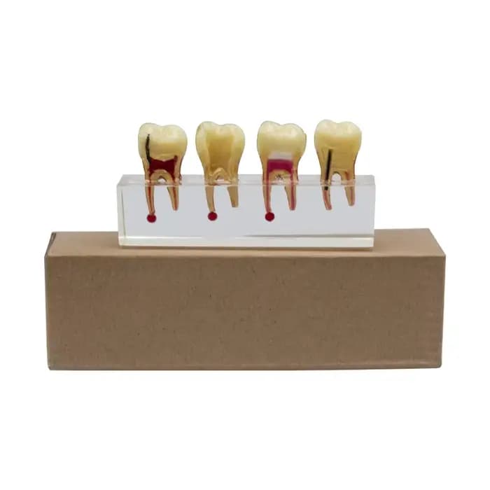 Modèle dentaire pour l'enseignement et la formation au traitement de la pulpe et des caries, modèle de démonstration de restauration de la pulpe des dents de lait chez l'enfant