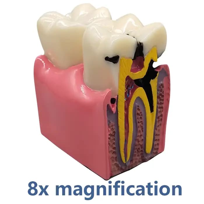 Modèle de caries dentaires 8 fois, modèle dentaire pour la maladie des dents, modèle de démonstration dentaire, enseignement du dentiste, laboratoire dentaire, recherche orale