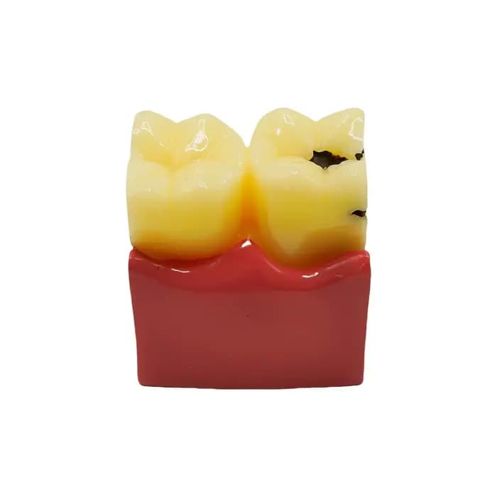 Modèles dentaires de comparaison de caries 6 fois, modèles d'étude pour dentiste, enseignement, pratique de l'anatomie, modèle de dents de dentisterie