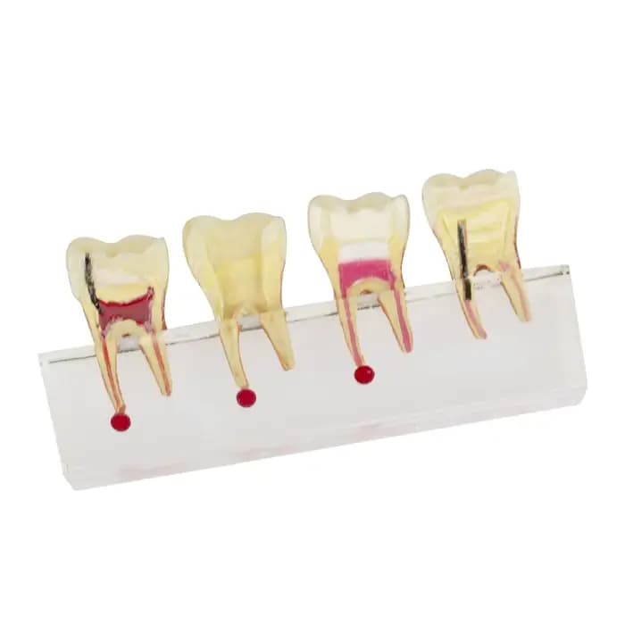 Modèle dentaire pour l'enseignement et la formation au traitement de la pulpe et des caries, modèle de démonstration de restauration de la pulpe des dents de lait chez l'enfant
