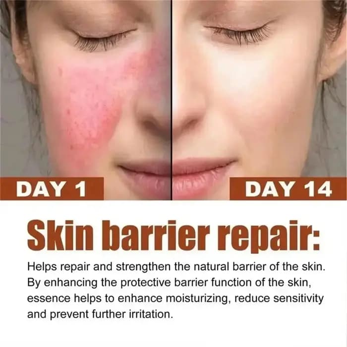 Crème réparatrice pour les rougeurs du visage